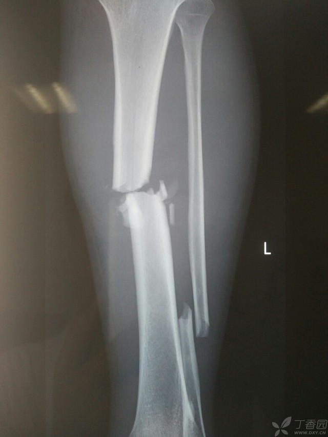 科技重塑脛腓骨骨折康復(fù)之旅，引領(lǐng)未來體驗新篇章