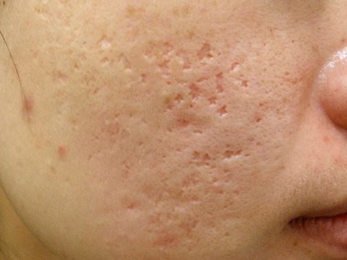 最新痘坑撫平神器，科技重塑肌膚之美，自信生活從此開始