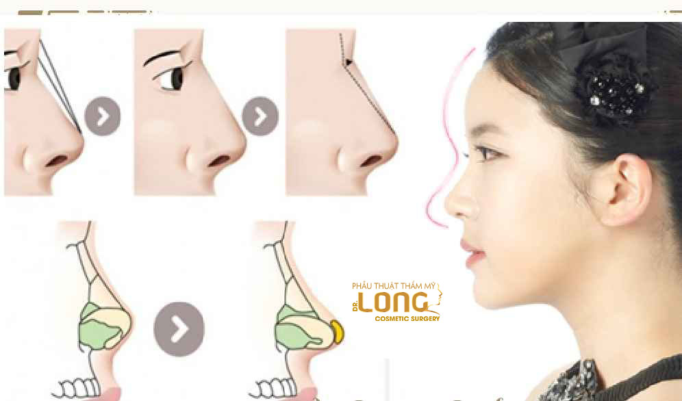 最新鼻整形技術(shù)重塑自信，煥發(fā)新生之美