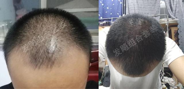 治愈脫發(fā)最新重大突破，重塑自信，希望之光再現(xiàn)